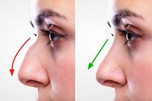 Rhinoplasty